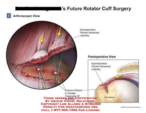 Future Rotator Cuff Surgery