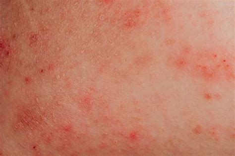 Red Spots on Skin: Causes, Diagnosis, and Treatments