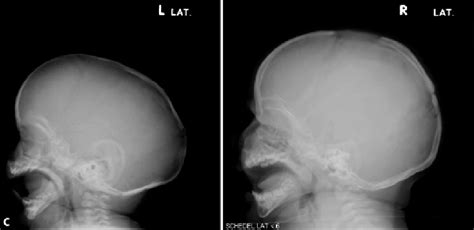 2.2a–c (continued) Picture of patient with sagittal synostosis, before ...