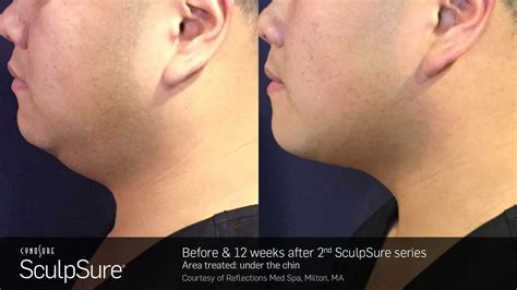 Laser Body Contouring - Before and After | SculpSure