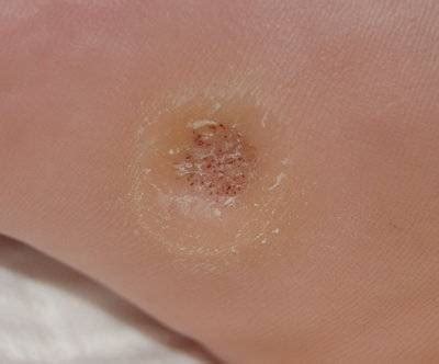 Plantar Warts: Symptoms, Causes, and Treatment Options