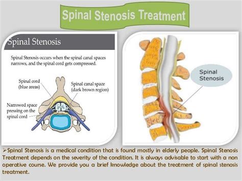 Lumbar spinal stenosis surgery