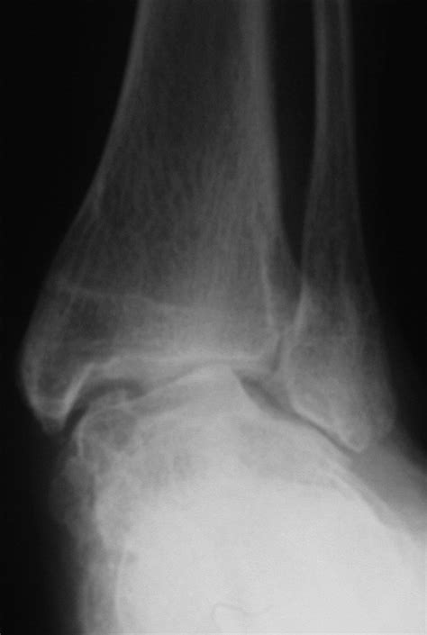 The Valgus Ankle - Foot and Ankle Clinics