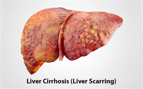 Cirrhosis : Causes, Signs, Symptoms & Treatment