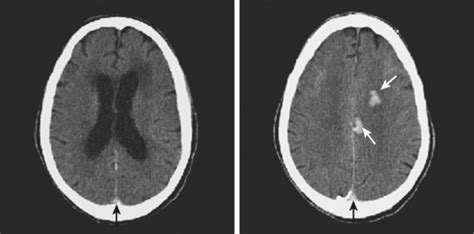 Cerebral Venous Thrombosis | Radiology Key