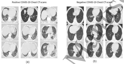 SARS-CoV-2 CT-scan dataset sample images: a) COVID-19 (+ve) patient's... | Download Scientific ...