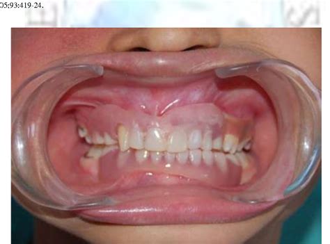 [PDF] Anhidrotic Ectodermal Dysplasia : The Dental Perspective : A Case ...