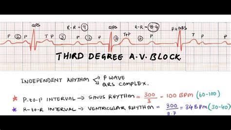 Third degree heart block/ complete A V block/ ECG interpretation of complete heart block - YouTube