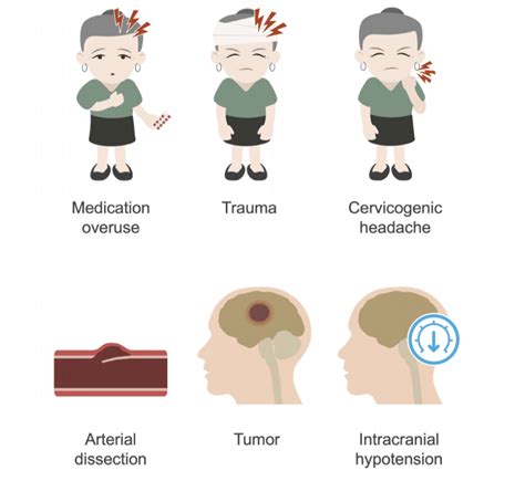 Chronic daily headaches • LITFL • Neurology library