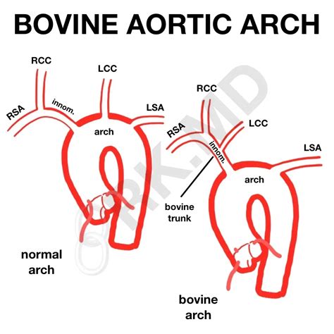 Bovine Aortic Arch | RK.MD