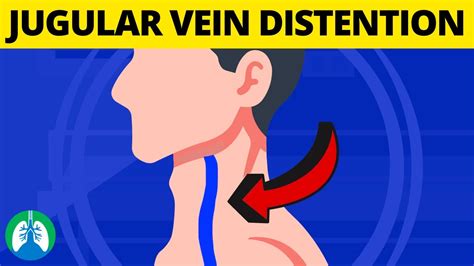 What is Jugular Venous Distention? (Medical Definition and Explanation) - YouTube