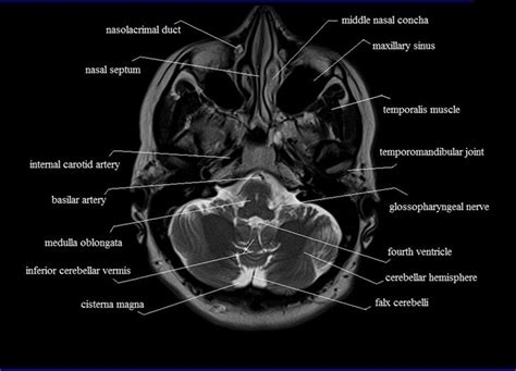 MRI anatomy | free MRI axial brain anatomy | Brain anatomy, Mri, Anatomy