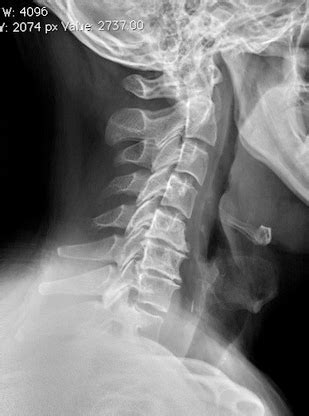 Cervical Spondylosis - Spine - Orthobullets