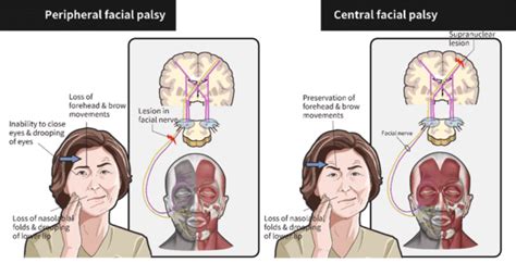 Bell’s Palsy: Clinical Presentation and Treatment - The ObG Project