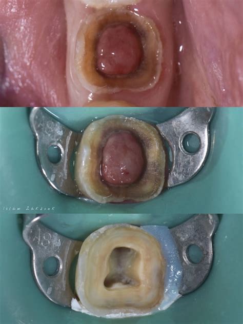 Endocrown .. Full documentation of a clinical case | Dental Esthetics