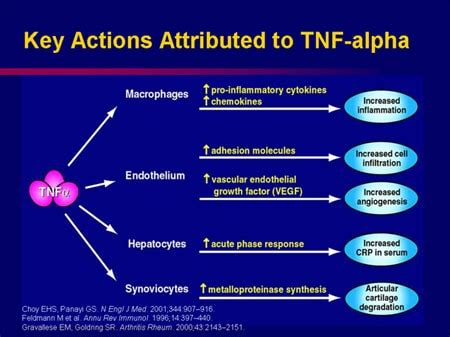 Refining the Focus: A New Look at Spondylitis