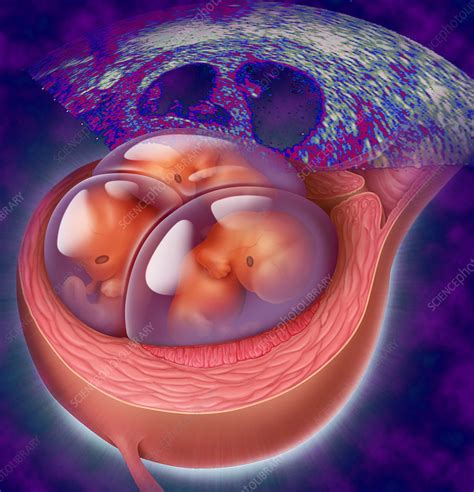 Triplet Fetuses - Stock Image - C001/5001 - Science Photo Library