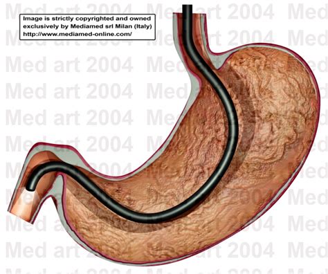 EGD - esophagogastroduodenoscopy. Causes, symptoms, treatment EGD - esophagogastroduodenoscopy