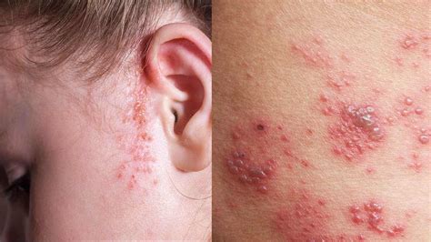 10 Rashes That Could Reveal a Dermatologic Disease