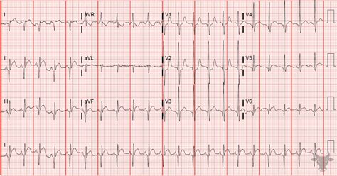 Dextrocardia | ECG Stampede