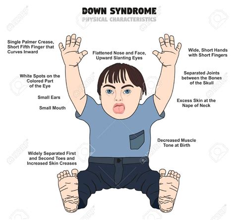 Fragile X Syndrome Diagram