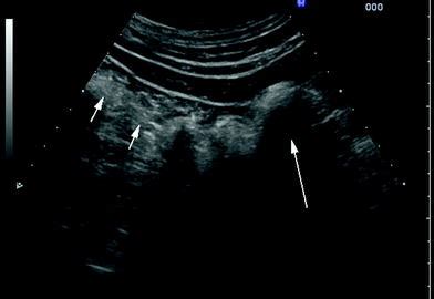 Bowel Ultrasound: Investigation Technique and Normal Findings | Radiology Key