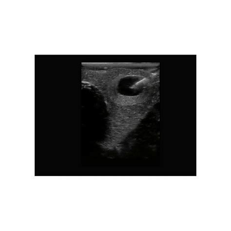 Thyroid Biopsy Ultrasound Training Block | Elevate Healthcare