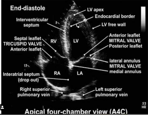 Echocardiographic assessment of aortic stenosis: a practical guideline from the British Society ...