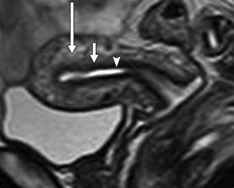 Uterus Anatomy Mri