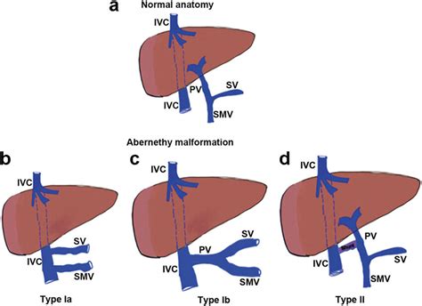 Hand-drawn diagrams suggesting congenital extrahepatic portosystemic ...