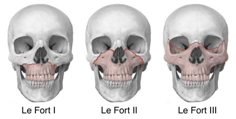 Le Fort Fracture | Definition, Fracture Types, And Symptoms