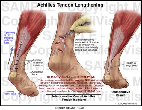 Achilles Tendon Lengthening Medical Illustration Medivisuals