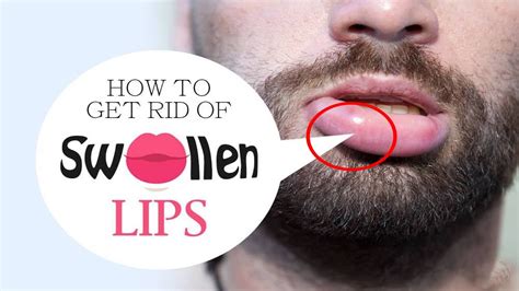 How To Reduce Swelling Of Lip - Treatbeyond2