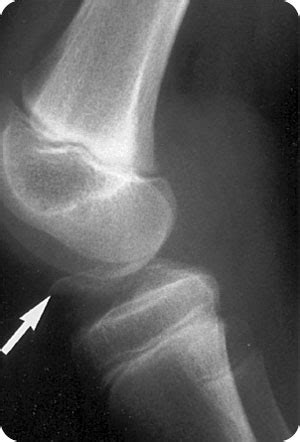 Tibial Spine Fracture Radiology