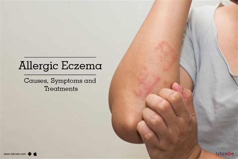 Allergic Eczema: Causes, Symptoms and Treatments - By Dr. Molly Joseph | Lybrate