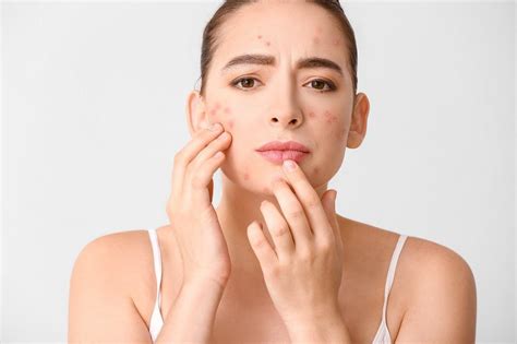 What's Really Going on Behind Your Pimples (and What to Do About It ...
