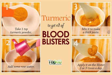 How to Get Rid of Blood Blisters | Top 10 Home Remedies