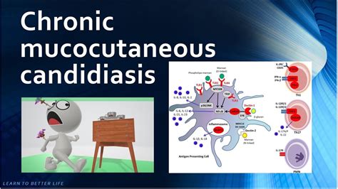 Chronic mucocutaneous candidiasis - Immunology USMLE Step 1 - YouTube