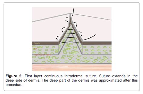 Double Layer Continuous Intradermal Sutures in Keloid Operation