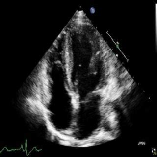 Parasternal short-axis view of the left ventricle showing normal size... | Download Scientific ...