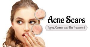 Acne Scar Treatment- Benefits and Side effects of Laser