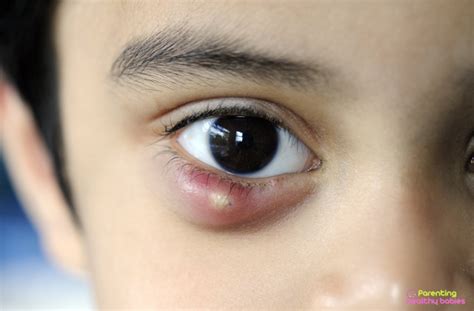 Chalazion in Children: Causes, Symptoms, Treatment and Prevention