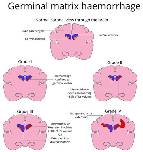 Germinal matrix hemorrhage causes, symptoms, diagnosis, treatment & prognosis