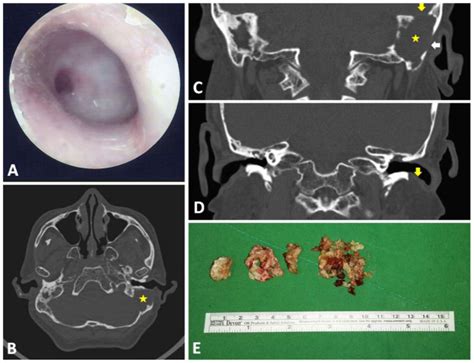 Huge Mastoid Cholesteatoma with Skull Base Erosion and CSF Leak ...