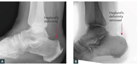 Picture Of Achilles Tendon - How To Rehab Achilles Tendinopathy ð —£ ð ...