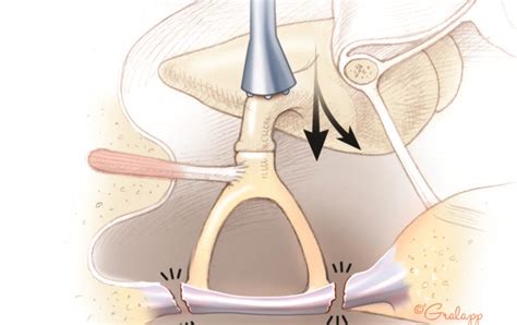 Tympanosclerosis – Oto Surgery Atlas