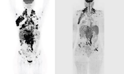 Comparison of whole-body diffusion-weighted magnetic resonance and FDG ...