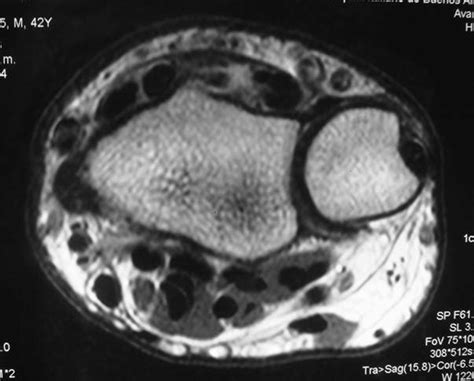 Extensor Pollicis Longus Mri