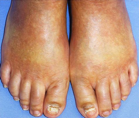 Drug-induced localised scleroderma | The BMJ