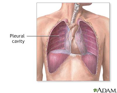 Pleural effusion Information | Mount Sinai - New York